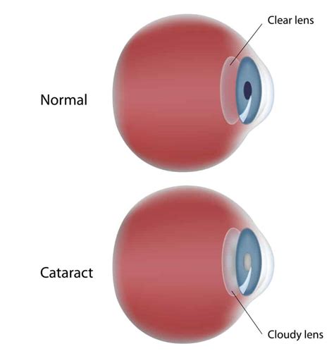 Lens Implants For Cataract Surgery You Have Choices Jahnle Eye Associates
