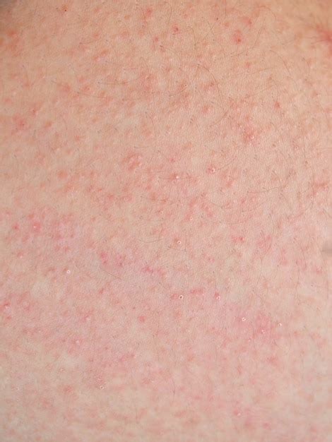 Premium Photo Allergic Rash Dermatitis Skin Of Patient