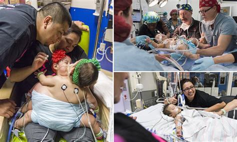 Cojoined Texas Twins Survive World First Operation To Separate Them
