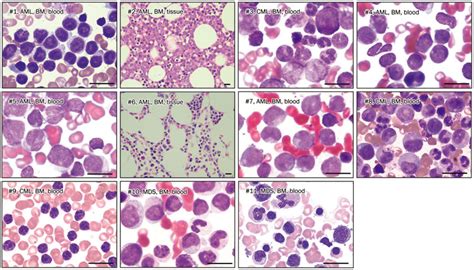 Morphology Of Bone Marrow Cells Derived From Patients