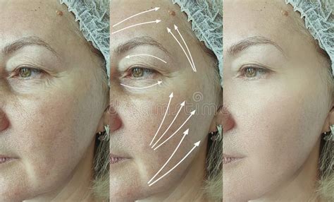 Elderly Woman Face Plastic Cosmetology Contrast Therapy Rejuvenation