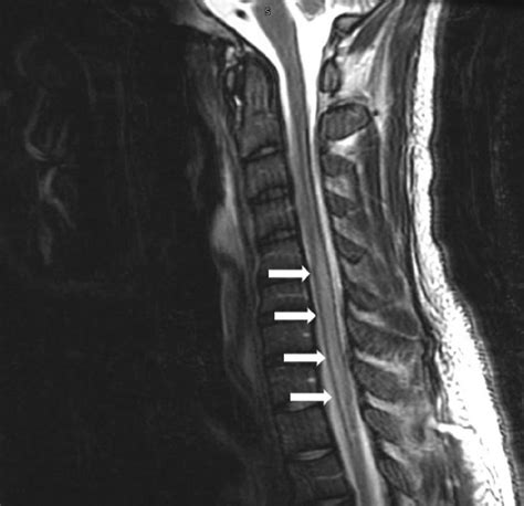 Mri Cervical And Thoracic Spine Sagittal T2 Spinal Cord Edema Spanning