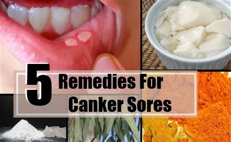 5 Top Home Remedies For Canker Sores Natural Treatments And Cure For