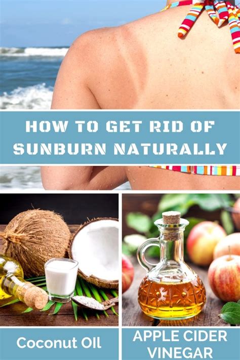 What's the best way to treat a sunburn? 10 Ultimate Home Remedies To Get Rid Of Sunburn Overnight ...