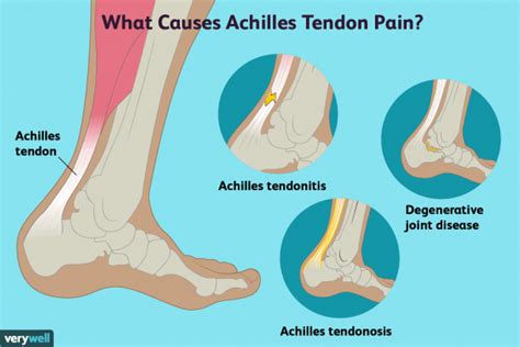 Related online courses on physioplus. Achilles Tendon Pain Causes, Treatment, And When To See A ...