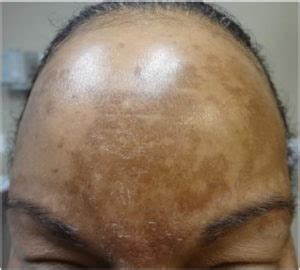 Melasma: Brown Patches on the Face - MDhairmixtress.com