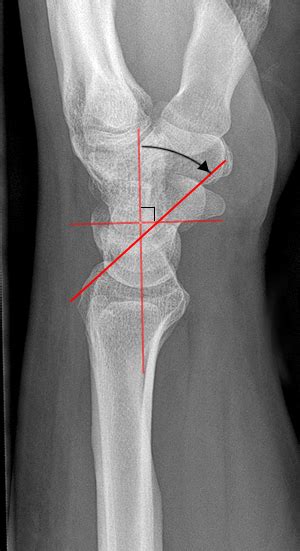 Imaging Scaphoid Fractures Wikiradiography