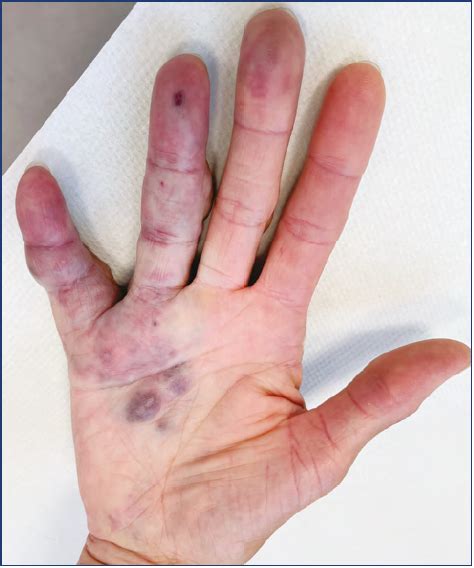 Venous Malformations Of The Hand Surgical Treatment Servier