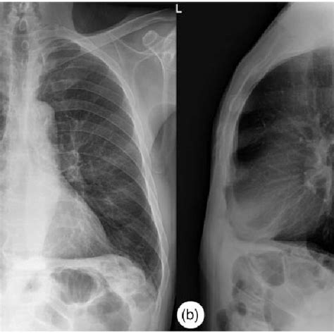 A Posteroanterior And B Lateral Chest Radiographs On Admission