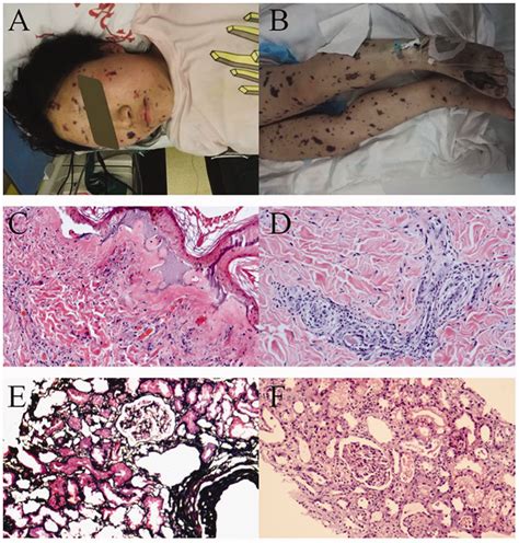 Systemic Ecchymosis And Skin And Renal Pathologic Findings Of Case 2 A