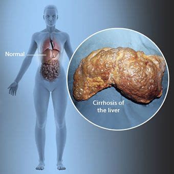 What Is Cirrhosis of the Liver? Symptoms,Treatment, Causes & Stages ...