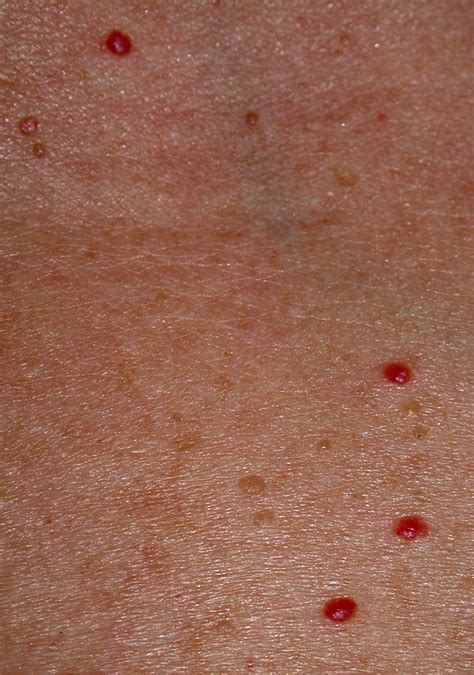 What Causes Red Spots On Skin