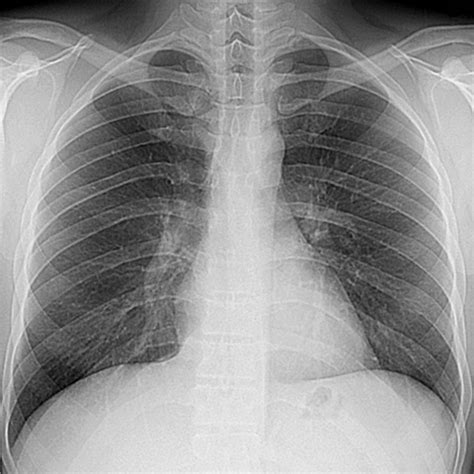 Normal Pa Chest Radiograph On Inspiration Of