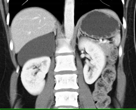 Adrenal Cyst On The Right Spleen Case Studies Ctisus Ct Scanning