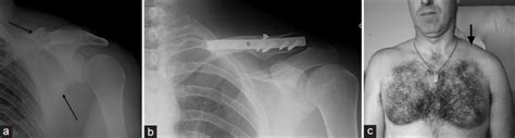 A Floating Shoulder With Midshaft Clavicular Fracture And Surgical