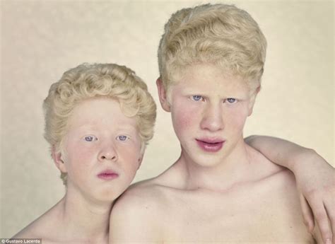 Albinos De Olhos Vermelhos