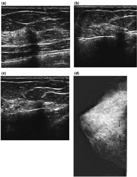 Transverse Us Image A Of The 11 10 8 Mm Irregular Hypoechoic