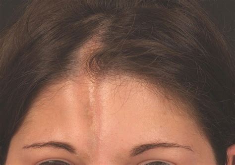 Esclerodermia Em Golpe De Sabre