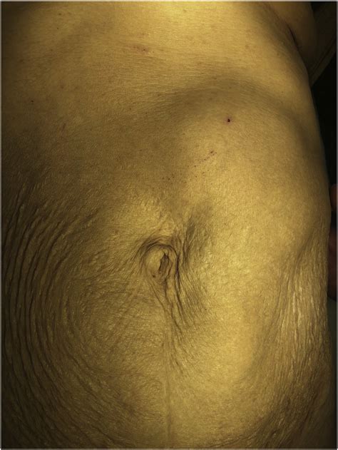 Picture Of The Abdomen Of The Patient Showing The Large Visible Mass In
