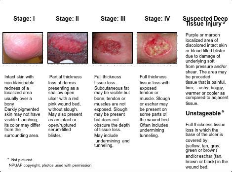 Figure B Depicts The Npuap Pressure Ulcer Stages I Iv With Descriptions Of The Stages And An