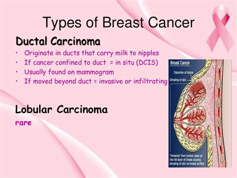 breast cancer ppt