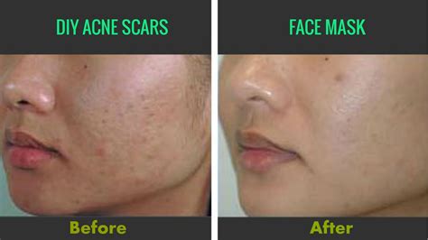 Get Rid Of Acne Scars And Dark Spots Fast At Homeflawless Skindiy Face