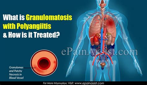 What Is Granulomatosis With Polyangiitis And How Is It Treated Causes