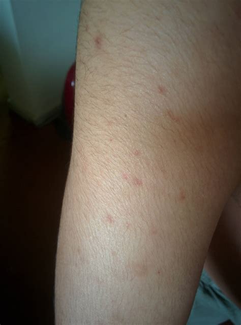Skin Concern What Are These Spots On My Arm Skincareaddiction