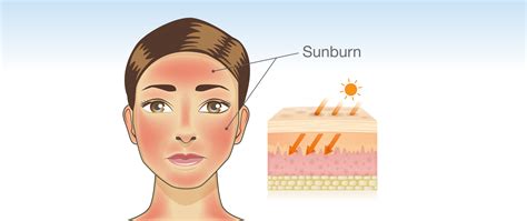 Mild Sunburn Face