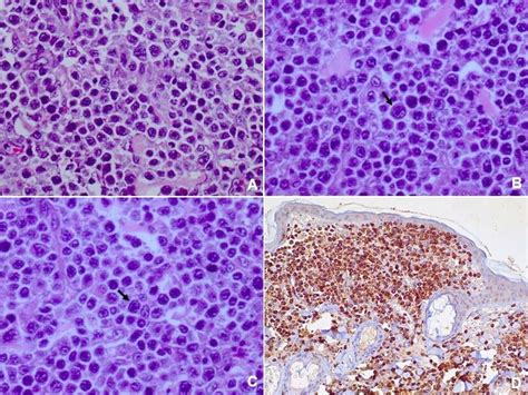Primary Cutaneous Anaplastic Large T Cell Lymphoma In A Female Cat