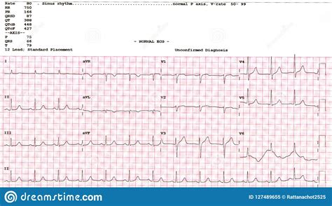 Cardiogram Waveform From An Ekg Showing Borderline Ekg Test Royalty