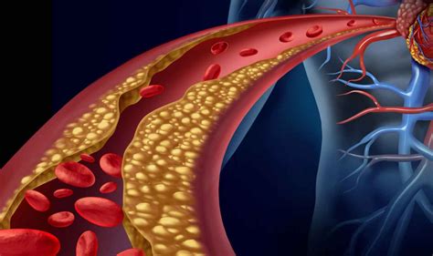 Qué es la dislipidemia causas y consecuencias Y la Tuya