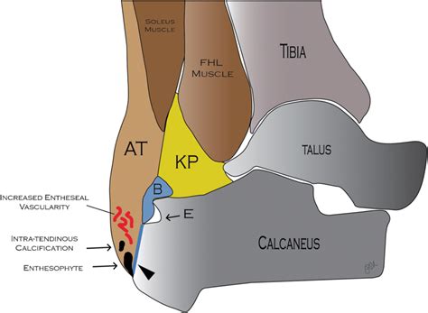 Schematic Of Achilles Tendon Enthesitis A Thickened Achilles Tendon Is