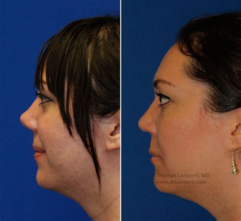 Rhinoplasty Patient 46 Before And After Left Profile Upturned Nose