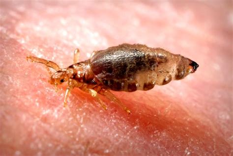 ALERT! California Typhus Outbreak