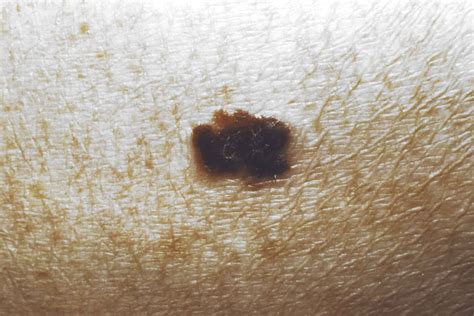 Skin Cancer Symptoms How To Check For Moles Readers Digest