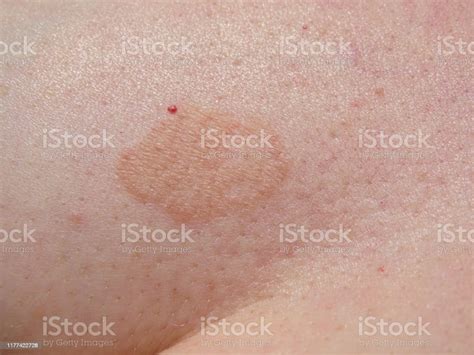 Fungal Skin Rash Infection Mark Close Up Of Patch Stock Photo