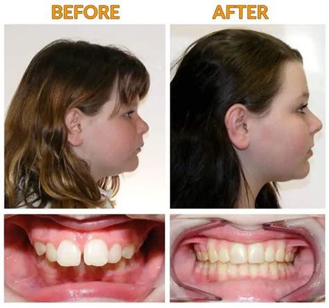 Braces Jaw Overbite Before And After Before And After Vrogue