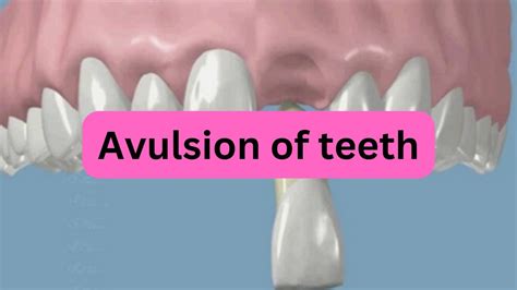What Is Avulsion Of Teeth Youtube