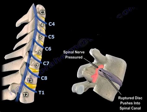 Neck Pain Cervical Disc Herniation And Cervical Radiculopathy By