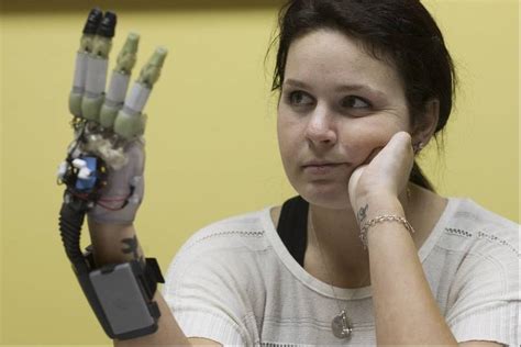 Young Woman Struggles To Adapt To Bionic Limb
