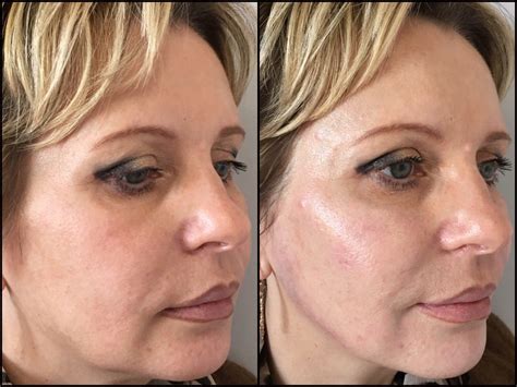 Dermal Fillers Before And After Photos Flora Levin Md