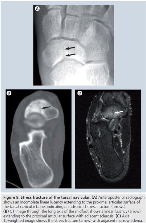 Imaging Of Running Induced Osseous Injuries