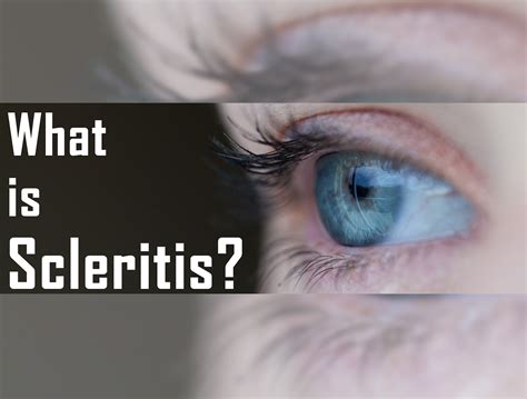 For Your Optical Needs Glasses Galore — What Is Scleritis Scleritis