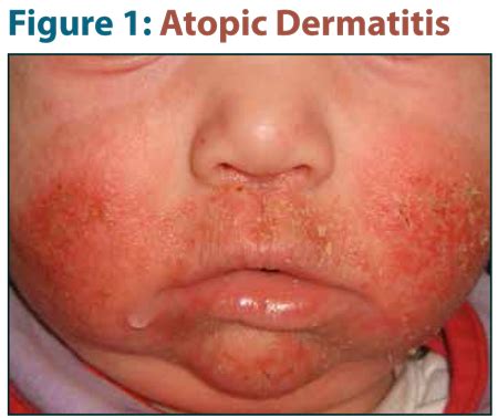 When to Scratch Beyond the Surface of the Diagnosis—A look at Atopic Dermatitis Mimickers and ...