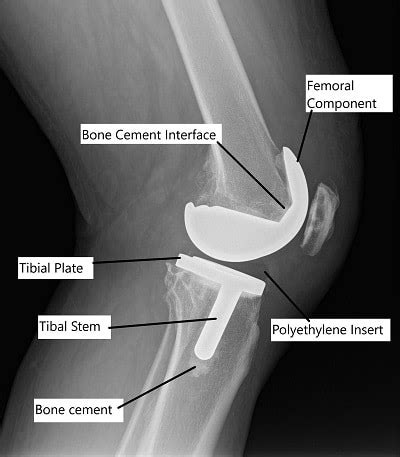 Cemented and Cementless Knee Replacement | Complete Orthopedics