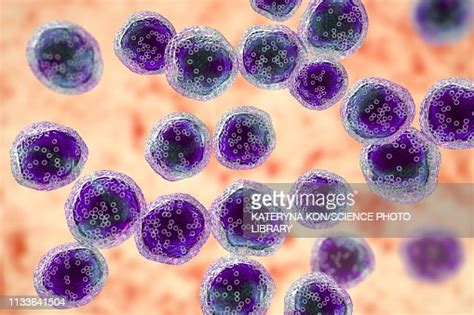 Burkitts Lymphoma Cells Illustration Ilustración De Stock Getty Images