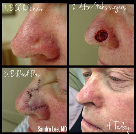 Melanomas come in many shapes and forms. Everything You Need to Know About Skin Cancer - Dr. Pimple ...
