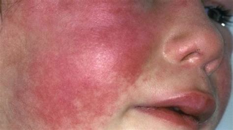 See full list on farmacoecura.it scarlattina viso