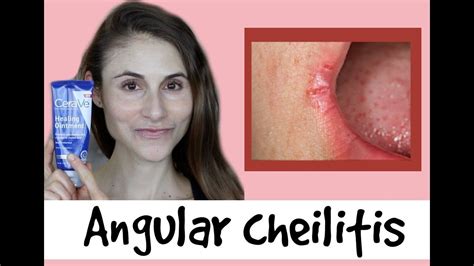 Signs And Symptoms Of Angular Cheilitis Will Almost Appear At The Edges Of The Mouth Discover